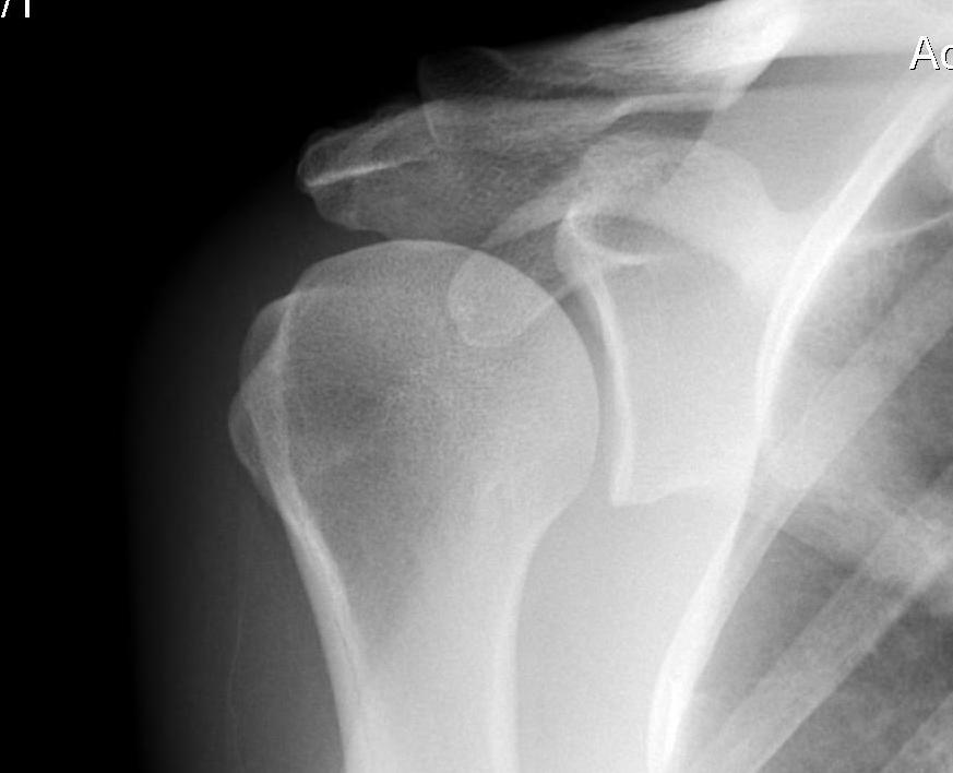 Coracoid Impingement Lateral Coracoid